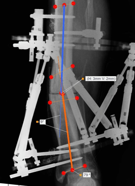 Radiograph from the Smart Fixator Prescription Calculation module, showing proximal and distal bone-axis overlays with translation and angulation annotations.