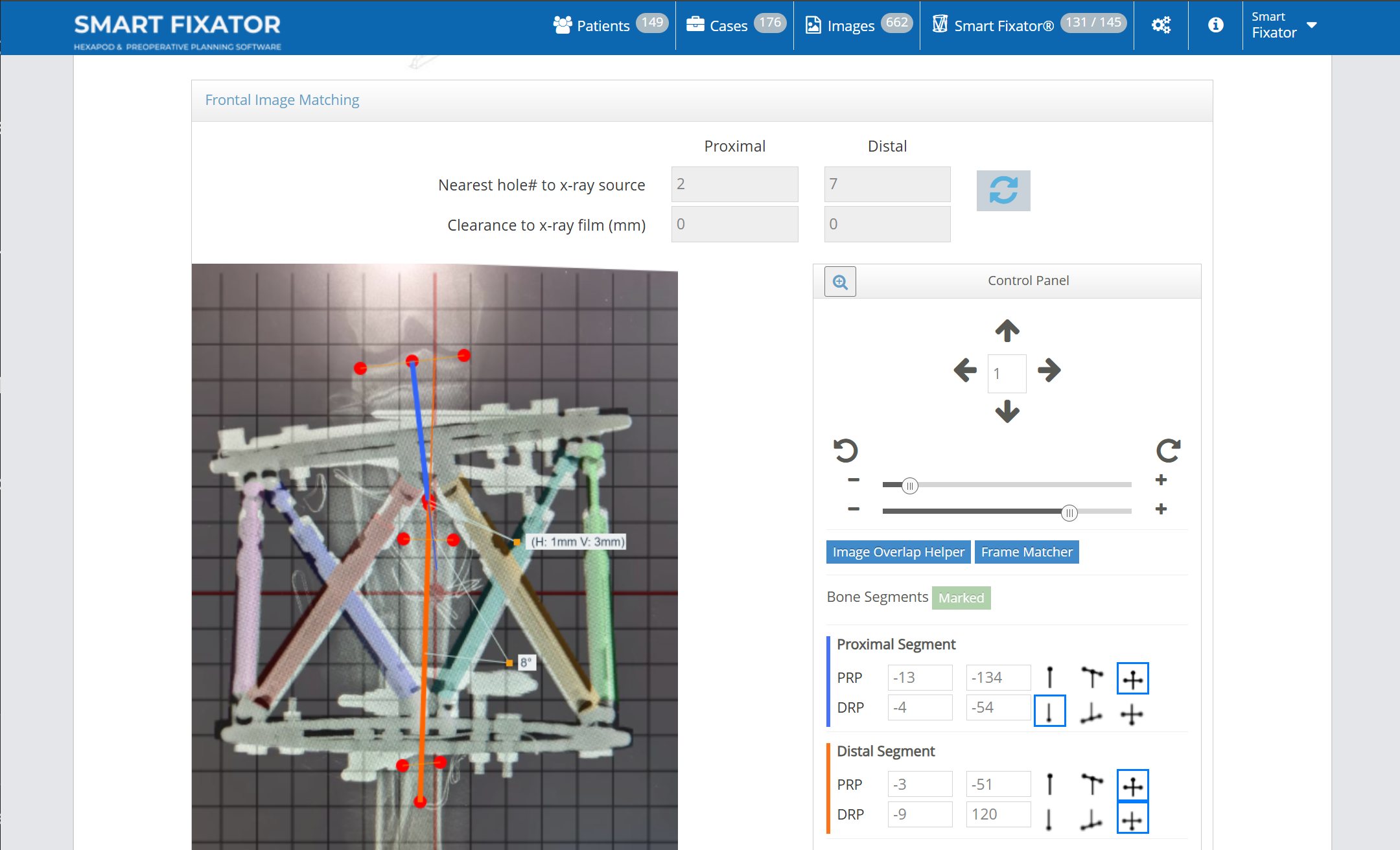 Smart Fixator software showing Frontal Image Matching, with the hexapod frame overlaid on a patient radiograph.